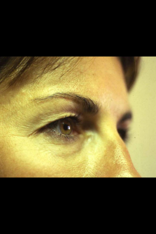 Eyelid Surgery