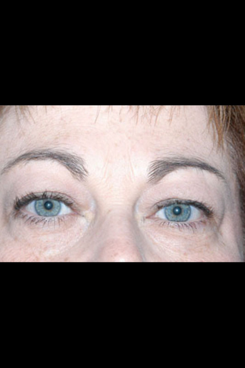 Eyelid Surgery