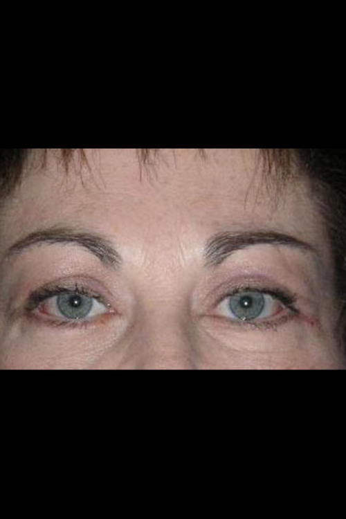 Eyelid Surgery