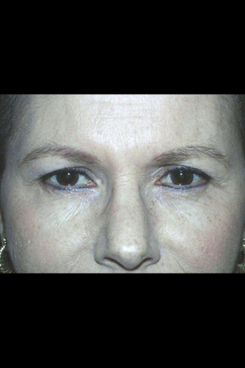 Eyelid Surgery