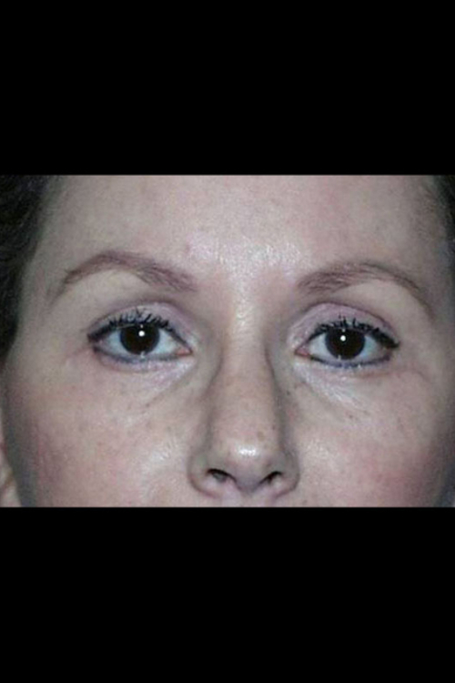 Eyelid Surgery