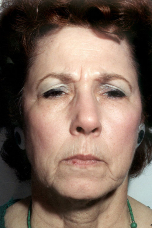 Eyelid Surgery