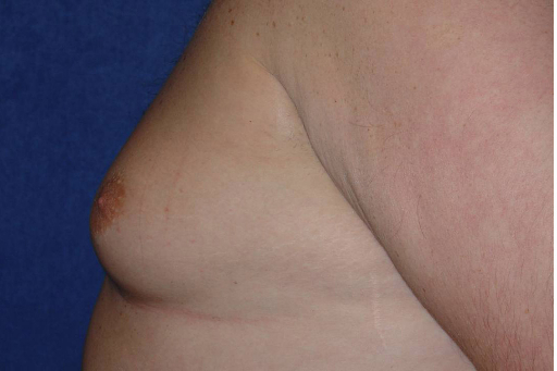 Gynecomastia