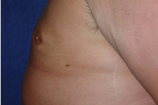 Gynecomastia