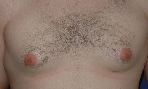 Gynecomastia