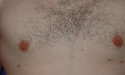 Gynecomastia