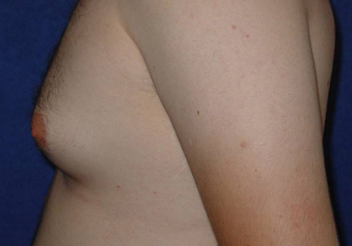 Gynecomastia