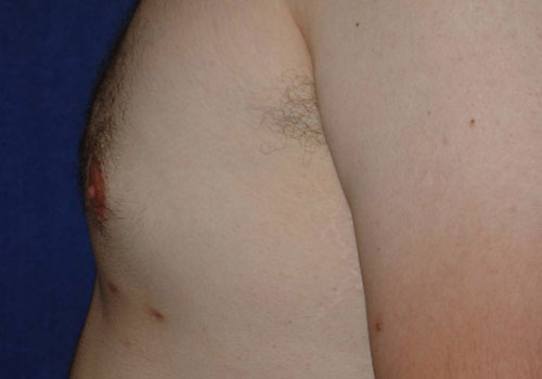 Gynecomastia