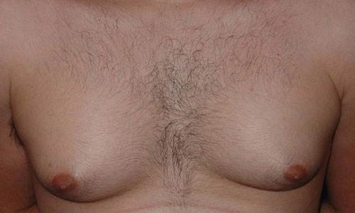 Gynecomastia