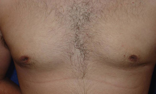 Gynecomastia