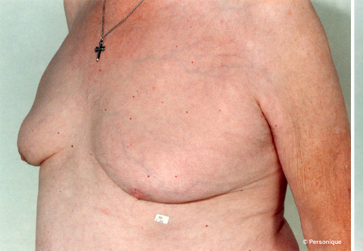 Gynecomastia