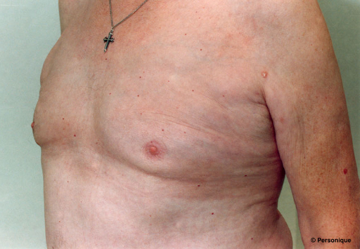 Gynecomastia