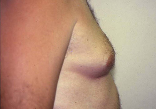 Gynecomastia