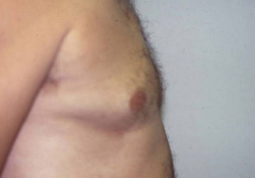 Gynecomastia