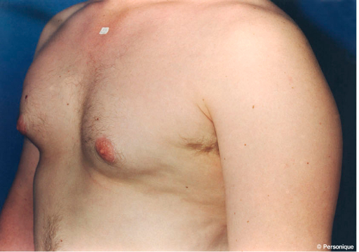 Gynecomastia