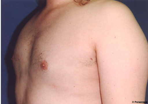 Gynecomastia