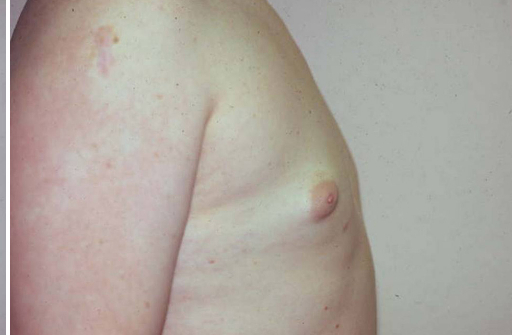 Gynecomastia