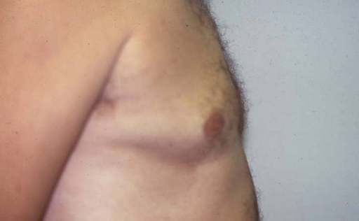 Gynecomastia