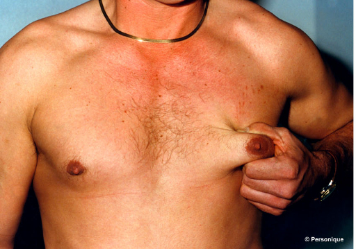 Gynecomastia