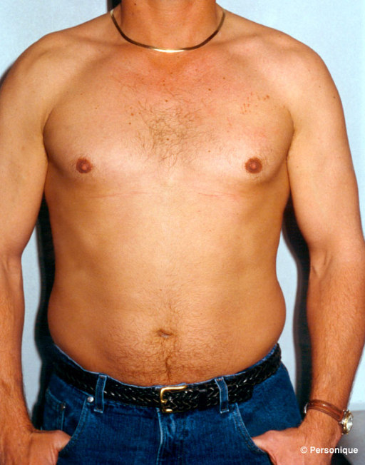 Gynecomastia