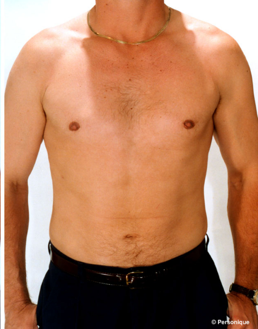 Gynecomastia