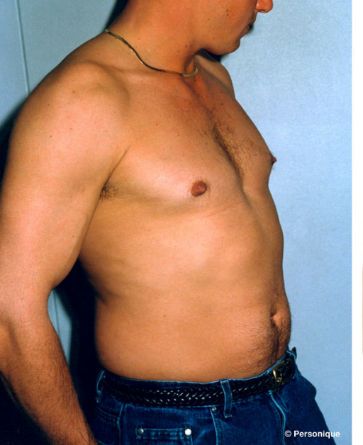 Gynecomastia