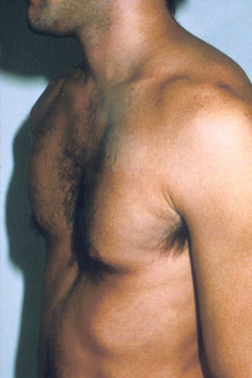 Gynecomastia