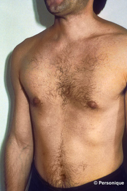 Gynecomastia