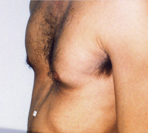 Gynecomastia