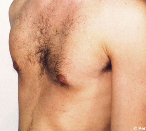 Gynecomastia