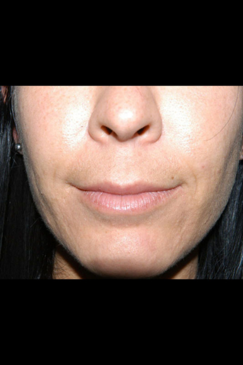 Lip Augmentation