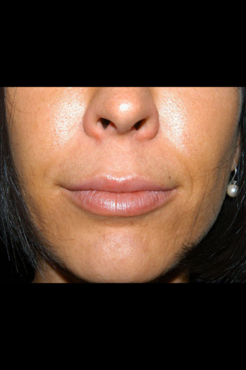 Lip Augmentation