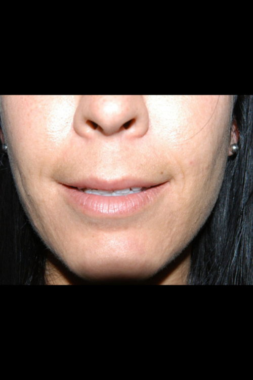 Lip Augmentation