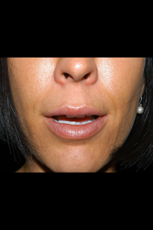 Lip Augmentation