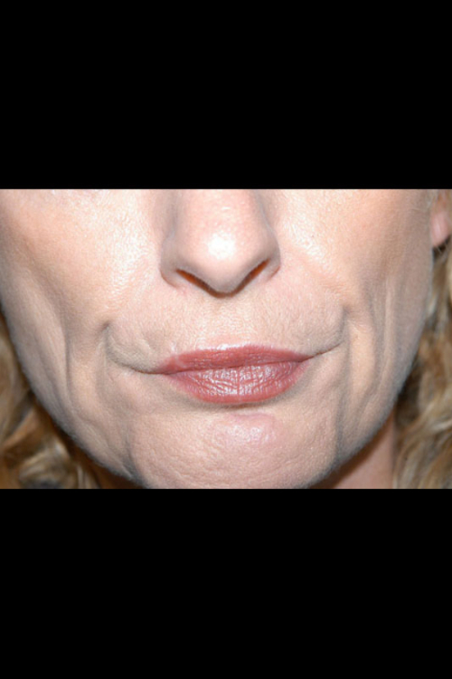 Lip Augmentation