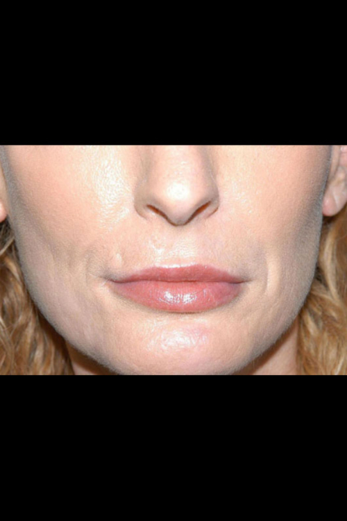 Lip Augmentation