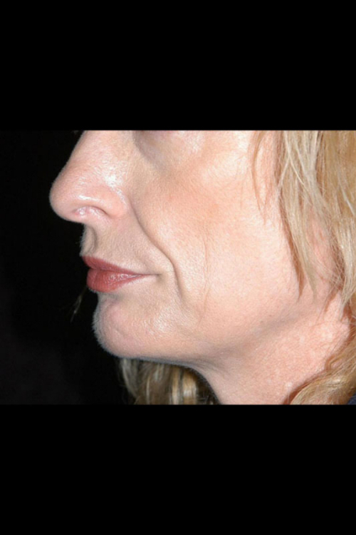 Lip Augmentation