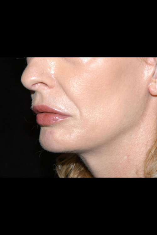 Lip Augmentation