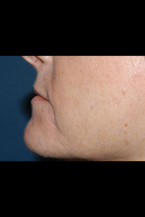 Lip Augmentation