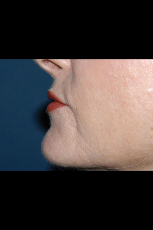 Lip Augmentation