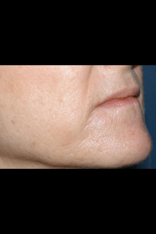 Lip Augmentation