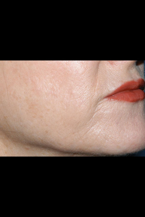 Lip Augmentation