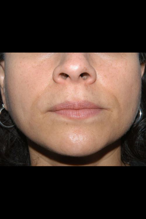 Lip Augmentation