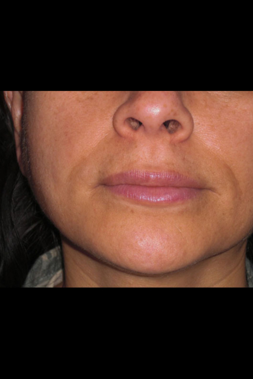 Lip Augmentation