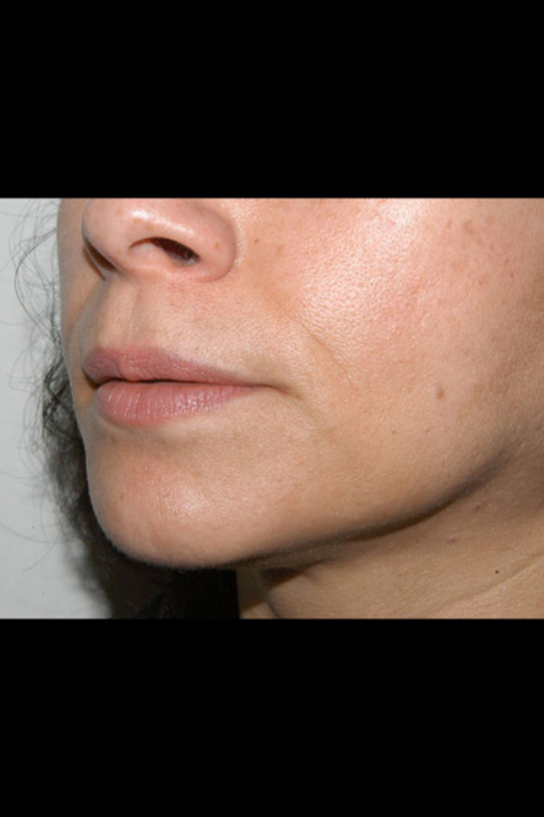 Lip Augmentation