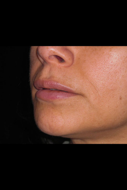 Lip Augmentation