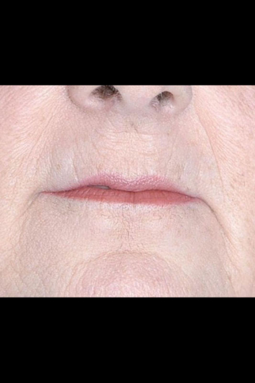 Lip Augmentation