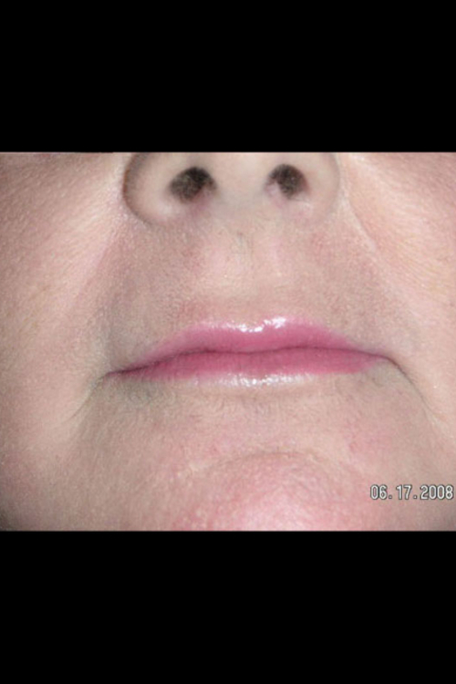 Lip Augmentation