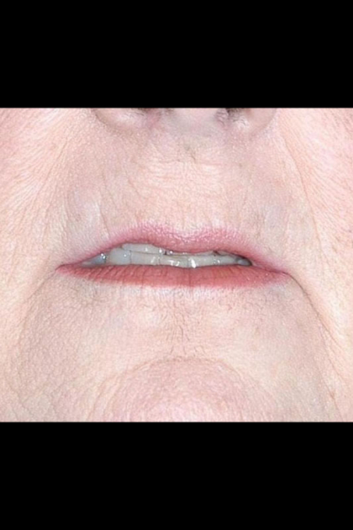 Lip Augmentation