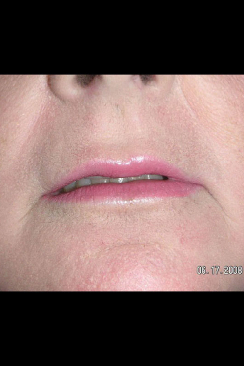 Lip Augmentation